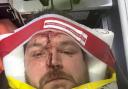 SURVIVOR: Rob Payne is lucky to be alive after the crash on the A44 at Pitchers Hill near Evesham